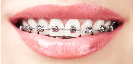teeth whitening